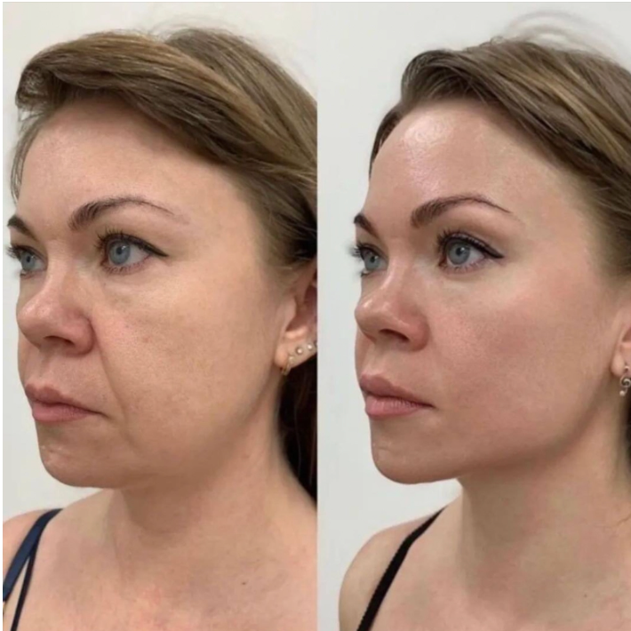 Ultherapy - The Original